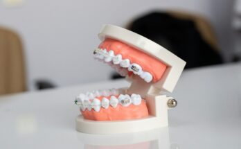 Can Retainers cause cavities