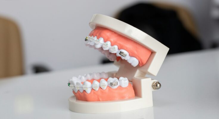 Can Retainers cause cavities